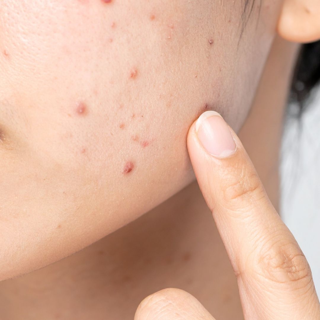 Macchie cutanee: perché dovresti cambiare la tua beauty routine con l’arrivo del primo caldo